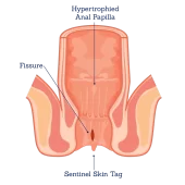 Anal-Fissure (1)